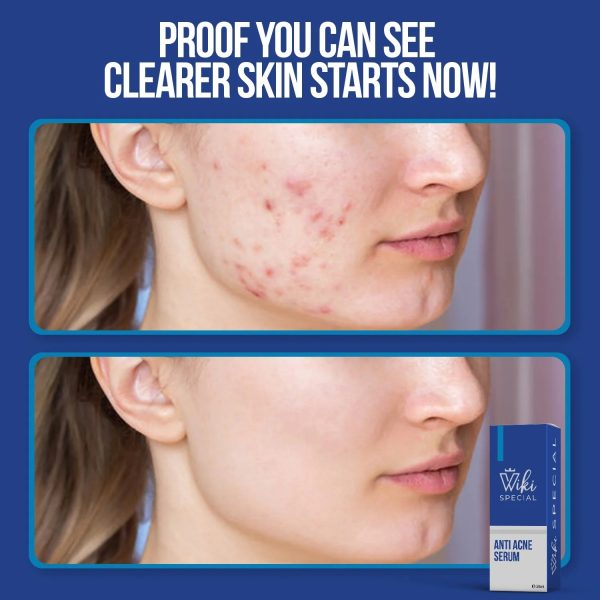 Wiki Special Anti Acne Serum – 30ml | Clears Acne, Soothes Skin & Fights Blemishes ‎Estimated Weight: 0.2kg